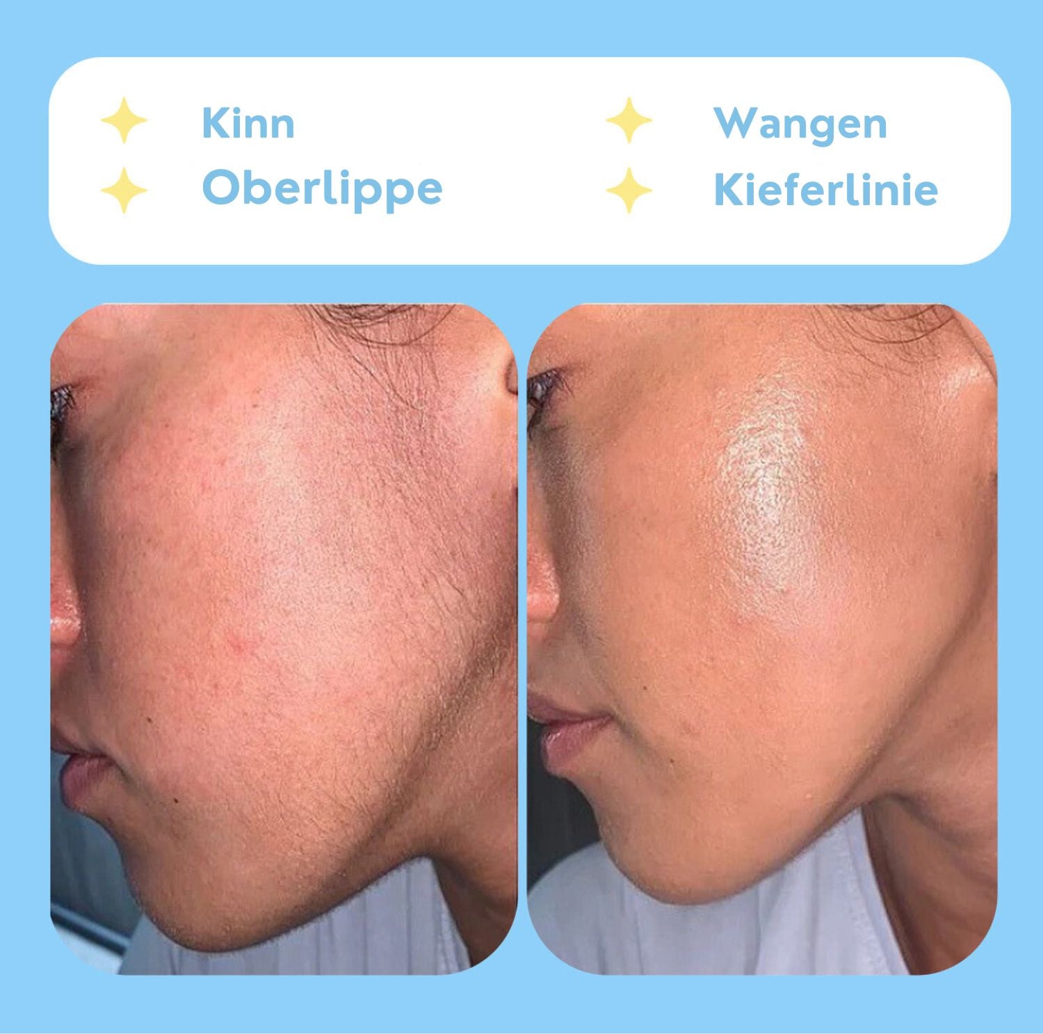 Serenosole™ BareBeauty Haar-Epilierer | Lässt deine Haut seidig weich anfühlen | Schmerzfreie Haarentfernung